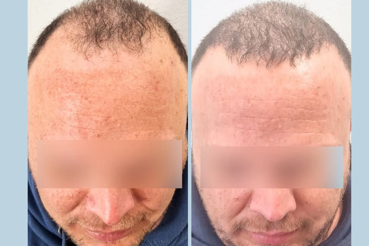 Μύθοι και αλήθειες για την τριχόπτωση