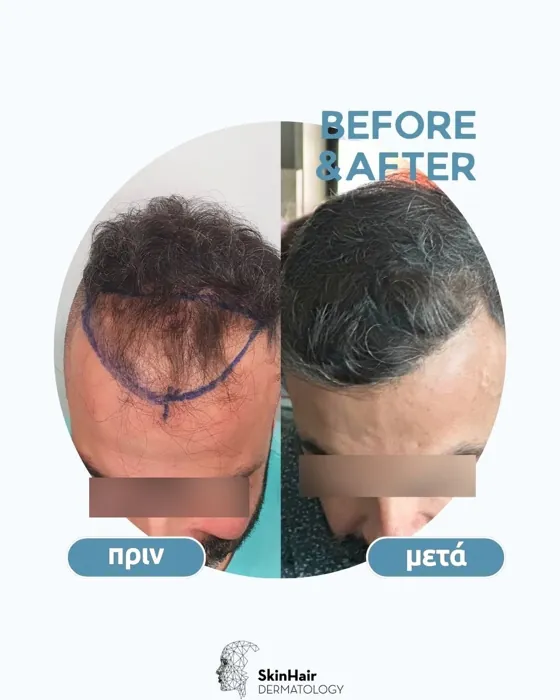 Αποτέλεσμα μεταμόσχευσης μαλλιών - περιστατικό