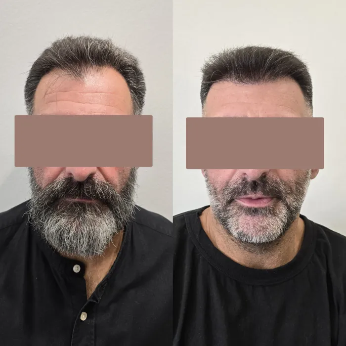 Αποτέλεσμα μεταμόσχευσης μαλλιών - περιστατικό