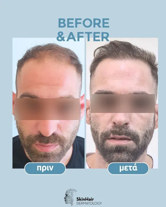 Αποτέλεσμα μεταμόσχευσης μαλλιών - περιστατικό