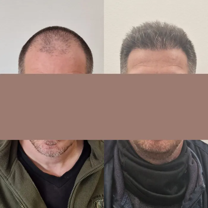 Αποτέλεσμα μεταμόσχευσης μαλλιών - περιστατικό