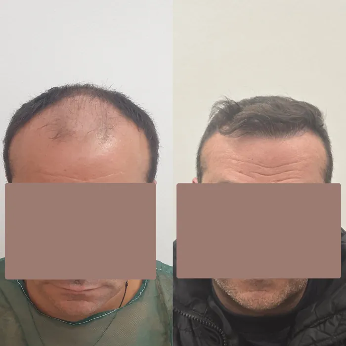Αποτέλεσμα μεταμόσχευσης μαλλιών - περιστατικό