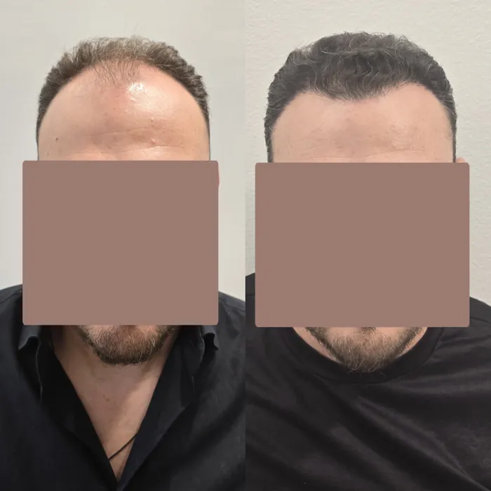 Αποτέλεσμα μεταμόσχευσης μαλλιών - περιστατικό