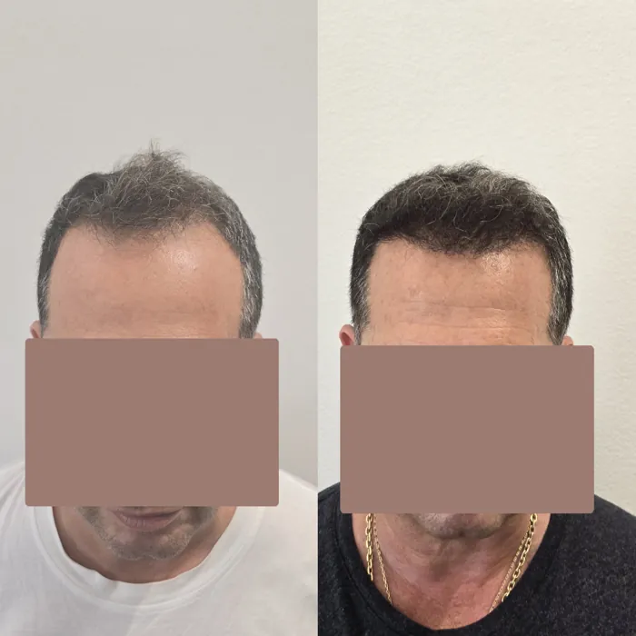 Αποτέλεσμα μεταμόσχευσης μαλλιών - περιστατικό