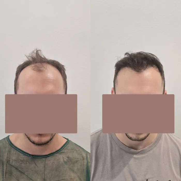 Αποτέλεσμα μεταμόσχευσης μαλλιών - περιστατικό