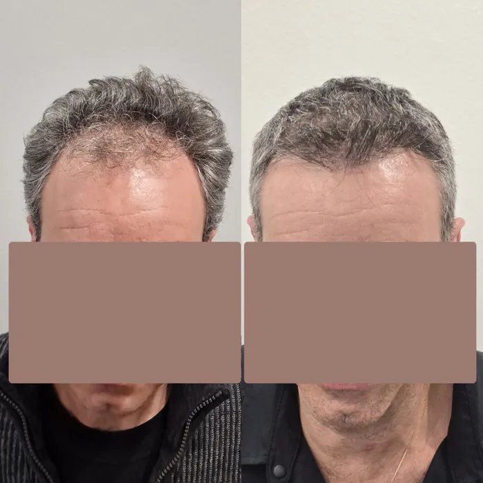 Αποτέλεσμα μεταμόσχευσης μαλλιών - περιστατικό