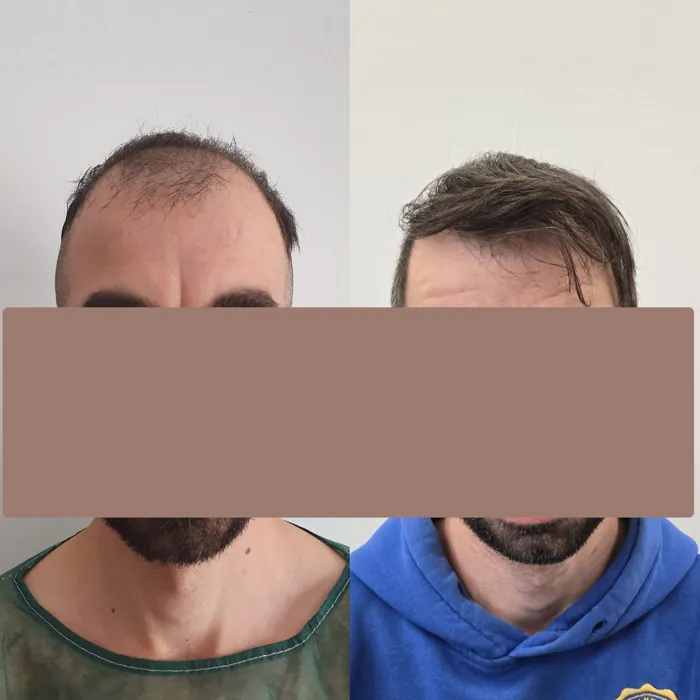 Αποτέλεσμα μεταμόσχευσης μαλλιών - περιστατικό