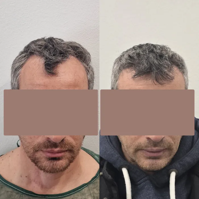 Αποτέλεσμα μεταμόσχευσης μαλλιών - περιστατικό