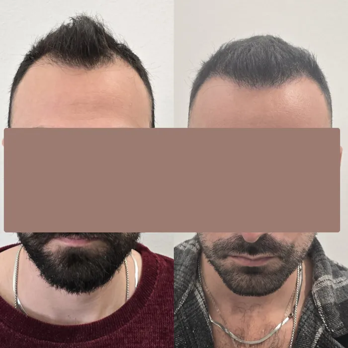 Αποτέλεσμα μεταμόσχευσης μαλλιών - περιστατικό